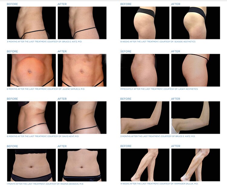 Machine HI Emslim RF Nova Machine HI Emslim RF Nova