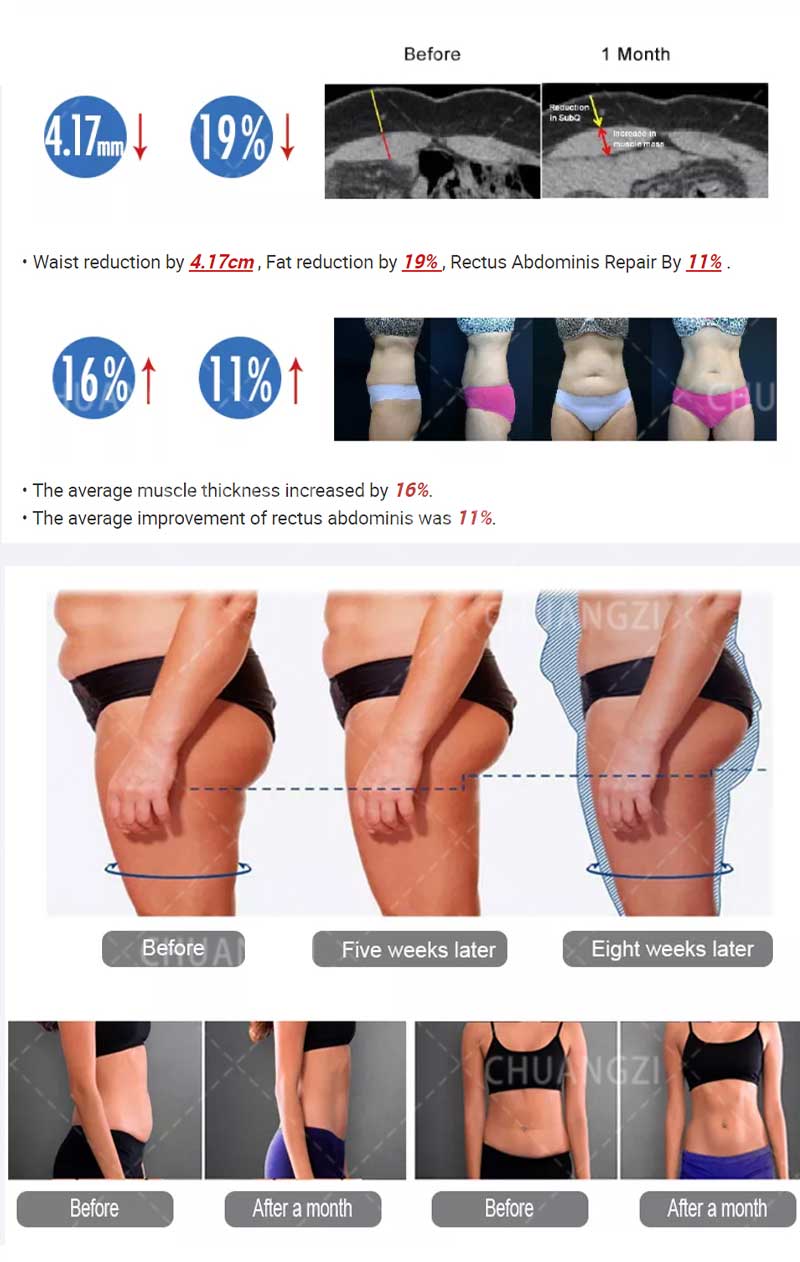 Machine HI Emslim RF Nova Machine HI Emslim RF Nova