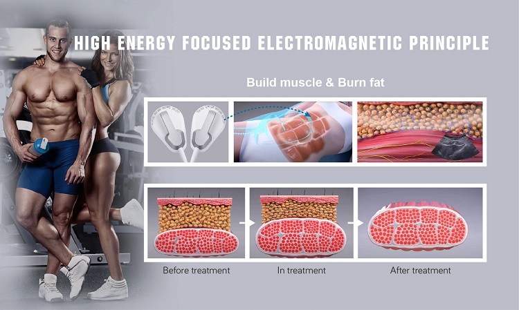 Machine HI Emslim RF Nova Machine HI Emslim RF Nova